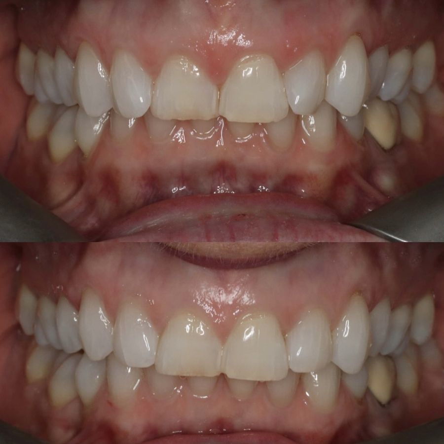 Front view of teeth before and after SureSmile clear aligner treatment