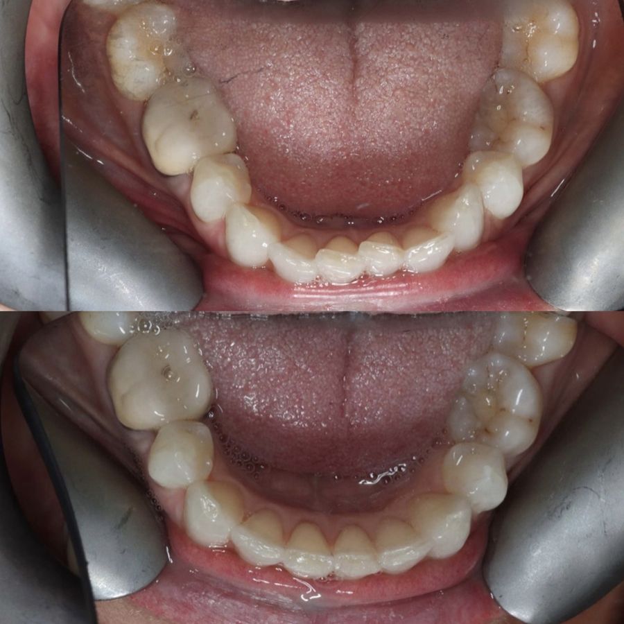 Lower teeth before and after SureSmile clear aligner treatment