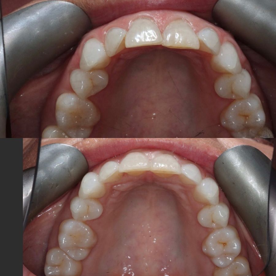 Upper teeth before and after SureSmile clear aligner treatment