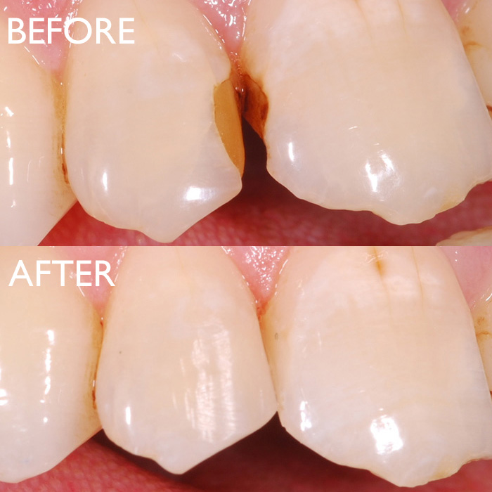 Replacing Old Discoloured Fillings
