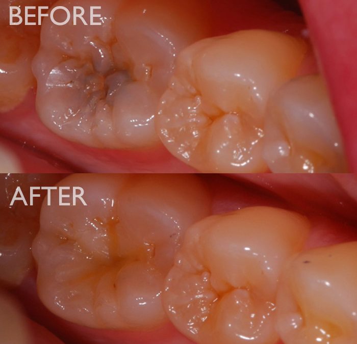 Restoring a Tooth with Decay