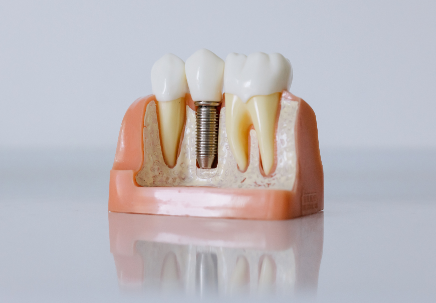 Dental Implant Model